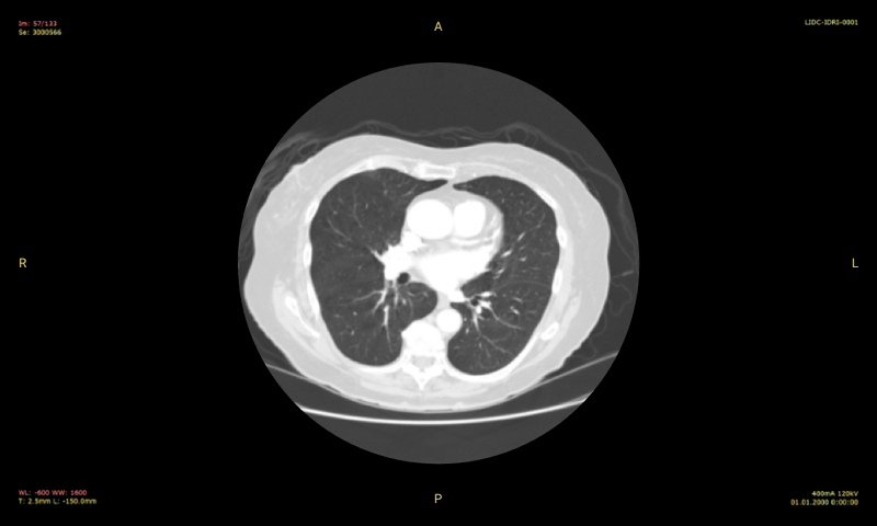 Medical Image Processing: Solitary Pulmonary Nodules in Lungs